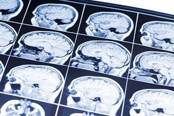 Philadelphia Brain Injury Lawyer