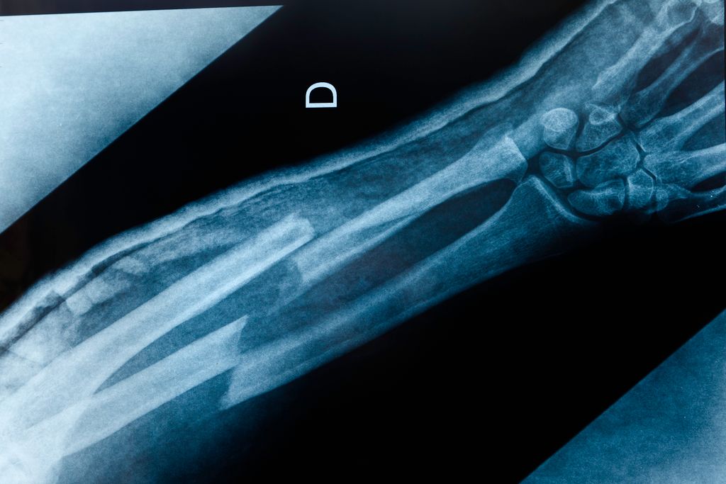 An x-ray image of a broken arm after a car accident.