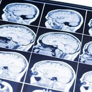 Philadelphia Brain Injury Lawyer